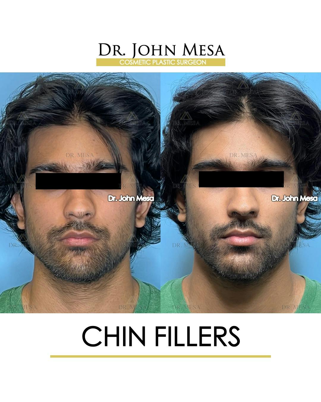 Chin Filler Before & After Gallery - Patient 638611 - Image 1