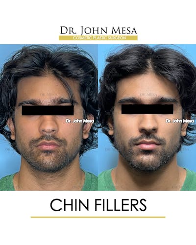 Chin Filler Before & After Gallery - Patient 638611 - Image 1
