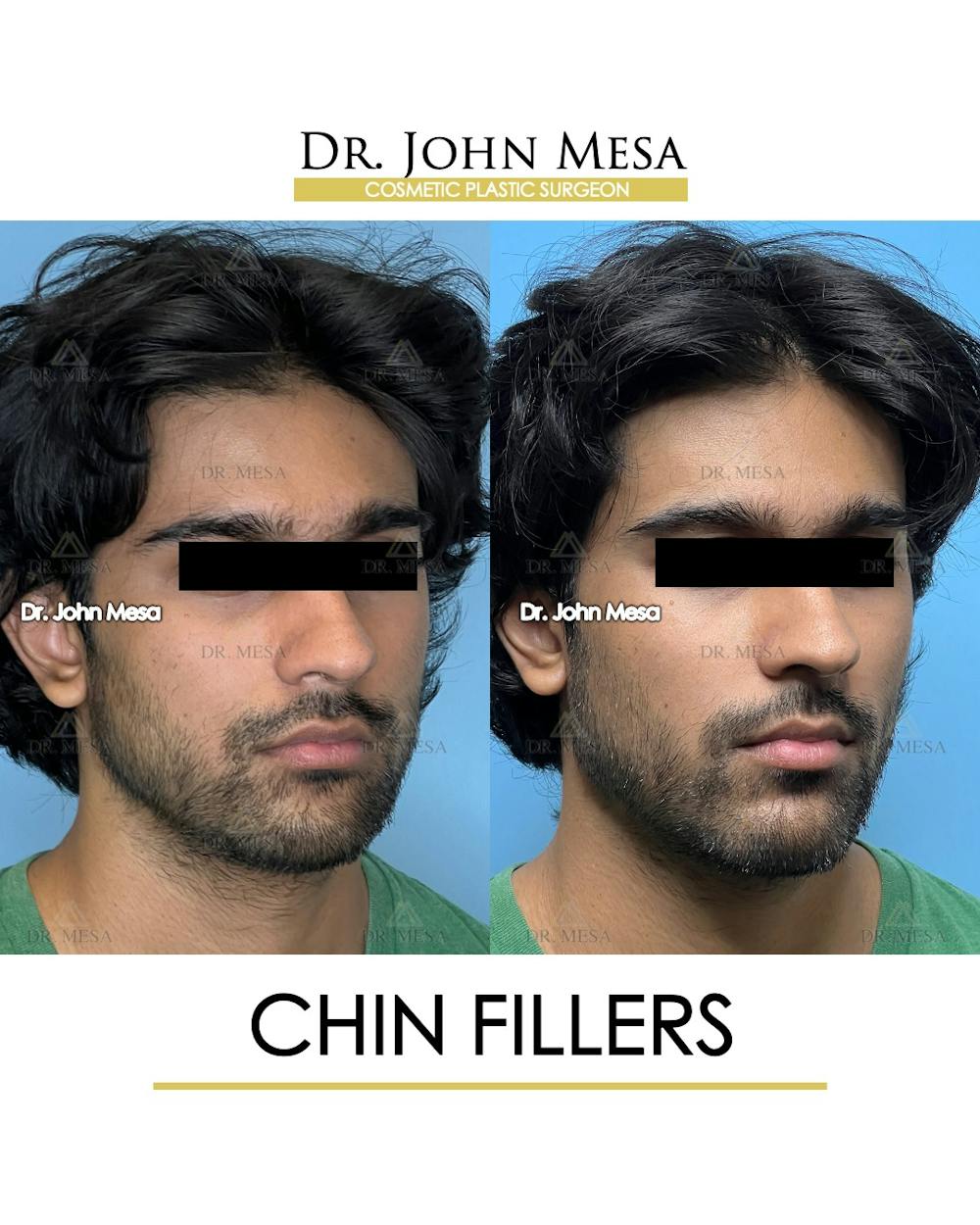 Chin Filler Before & After Gallery - Patient 638611 - Image 2