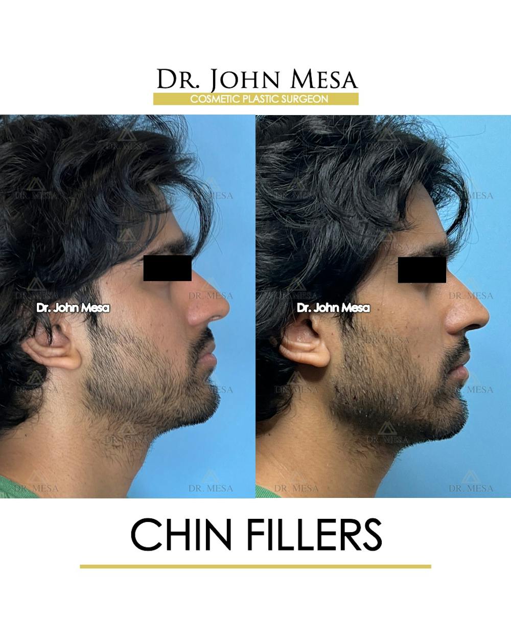 Chin Filler Before & After Gallery - Patient 638611 - Image 3