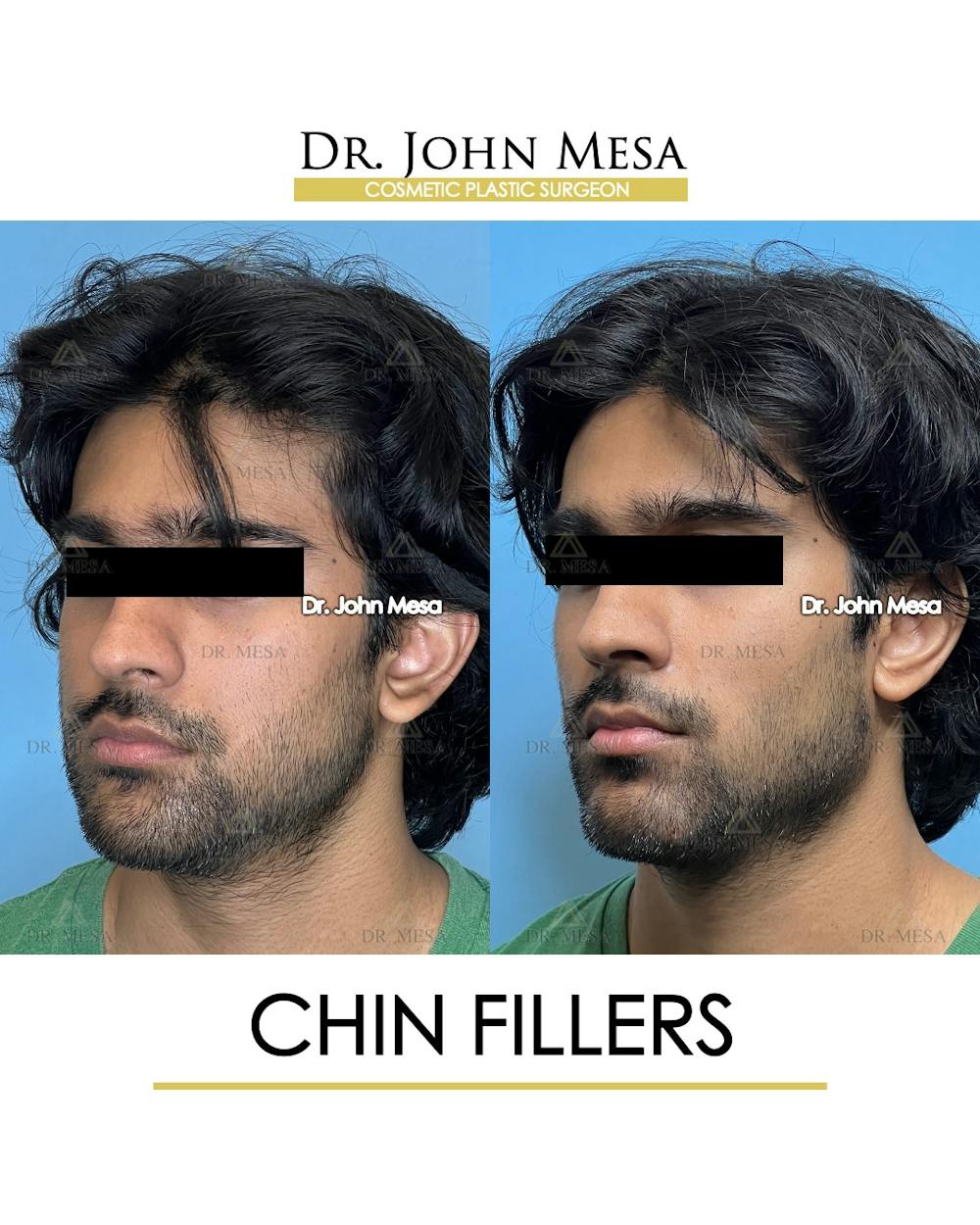 Chin Filler Before & After Gallery - Patient 638611 - Image 4