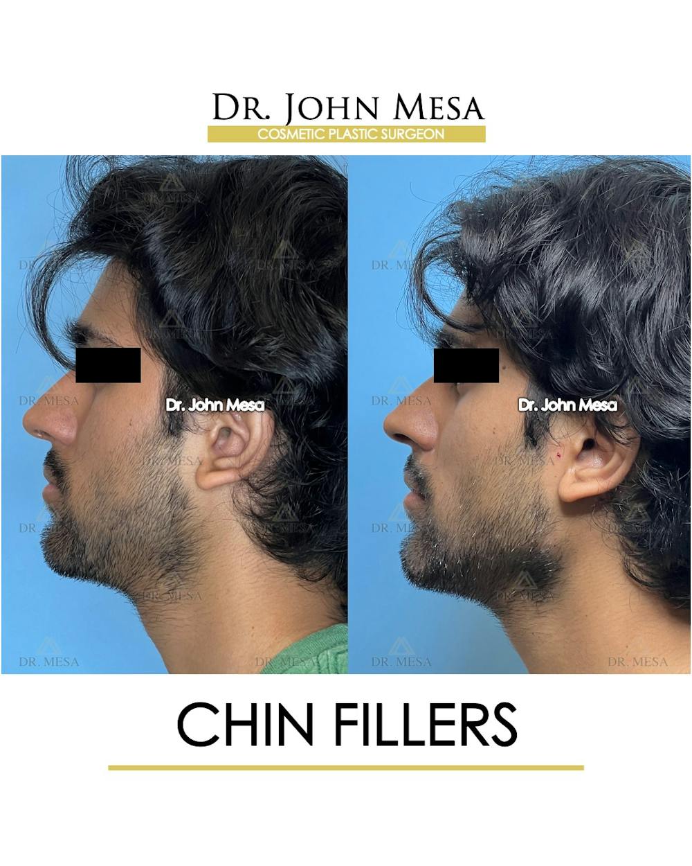 Chin Filler Before & After Gallery - Patient 638611 - Image 5
