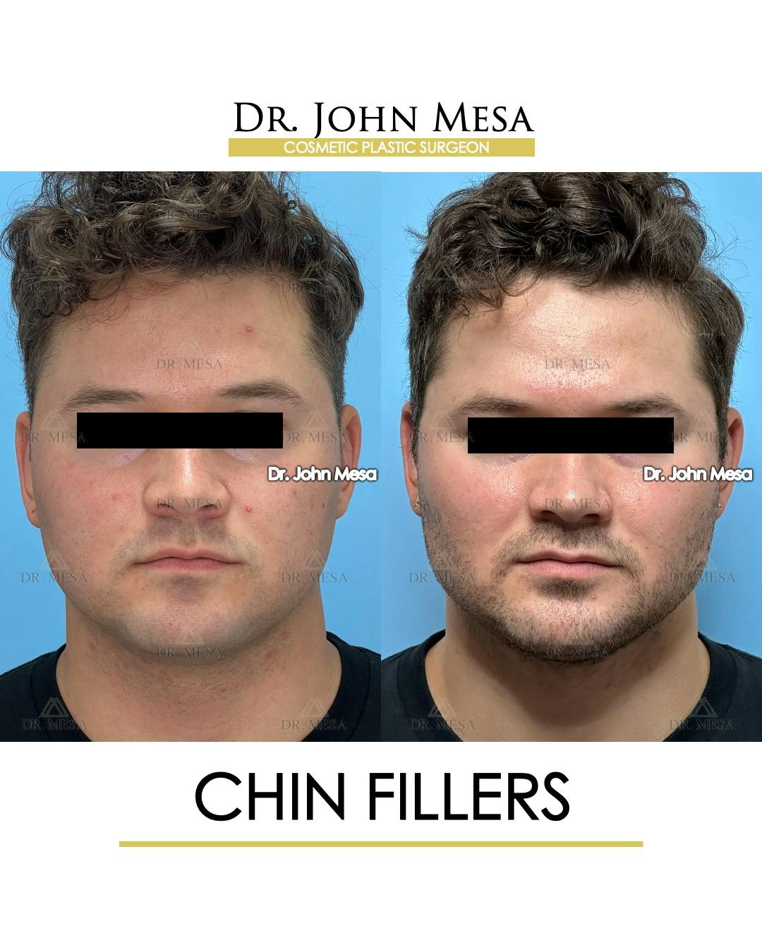 Chin Filler Before & After Gallery - Patient 166208 - Image 1