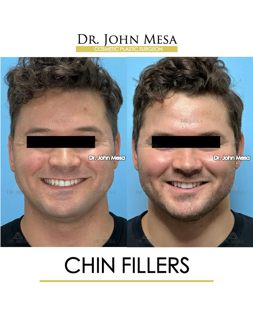 Chin Filler Before & After Gallery - Patient 166208 - Image 2