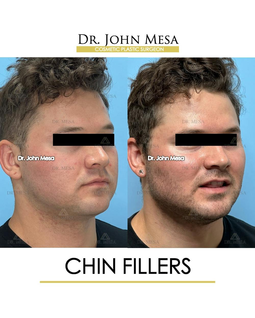 Chin Filler Before & After Gallery - Patient 166208 - Image 3