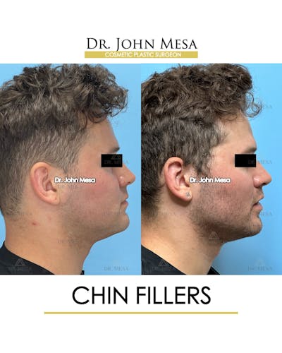 Chin Filler Before & After Gallery - Patient 166208 - Image 4