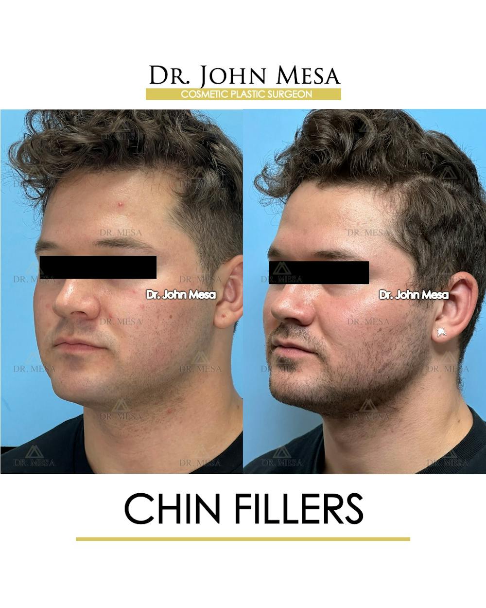 Chin Filler Before & After Gallery - Patient 166208 - Image 5