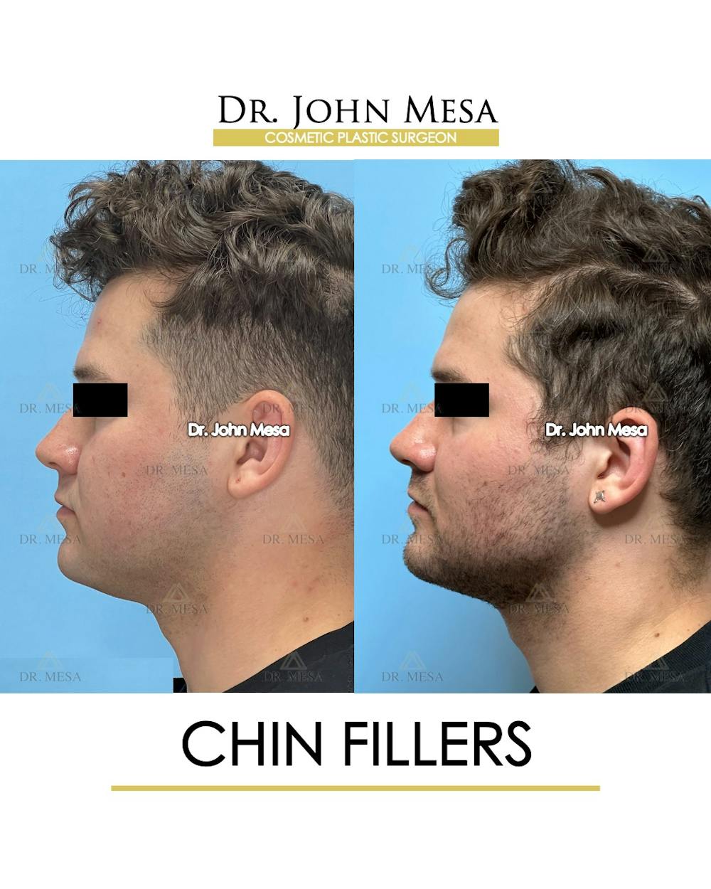 Chin Filler Before & After Gallery - Patient 166208 - Image 6