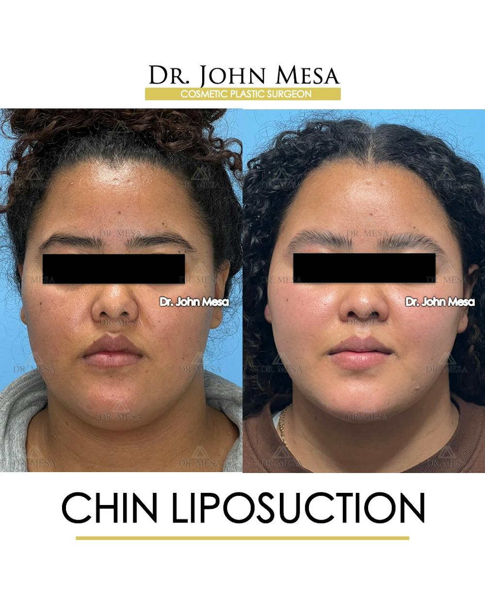 Chin Liposuction Before & After Gallery - Patient 911580 - Image 2