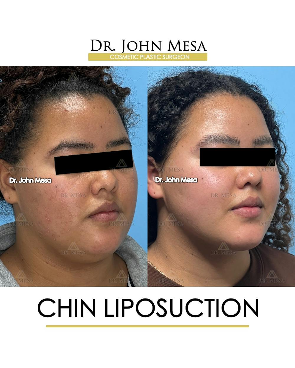 Chin Liposuction Before & After Gallery - Patient 911580 - Image 3