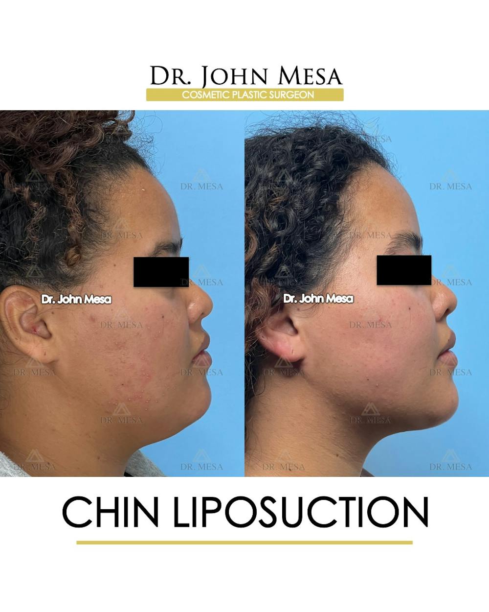Chin Liposuction Before & After Gallery - Patient 911580 - Image 1