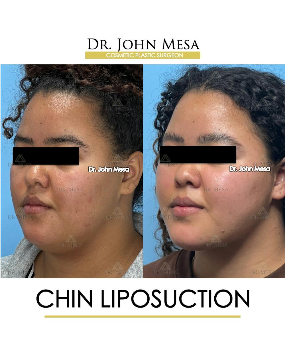 Chin Liposuction Before & After Gallery - Patient 911580 - Image 4