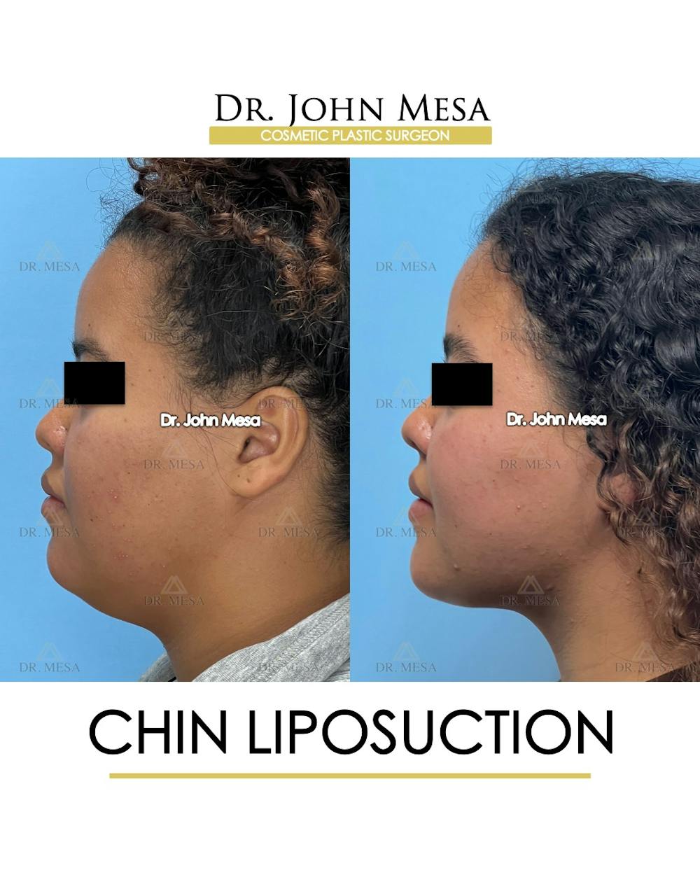 Chin Liposuction Before & After Gallery - Patient 911580 - Image 5