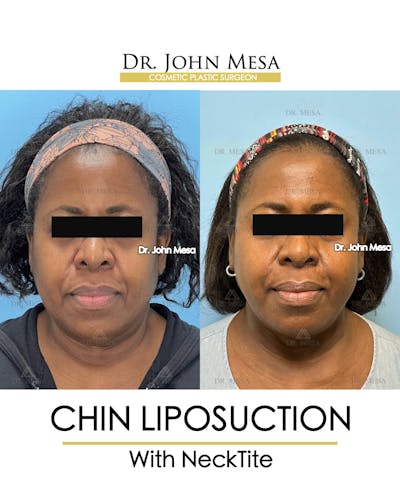 Chin Liposuction Before & After Gallery - Patient 695994 - Image 2
