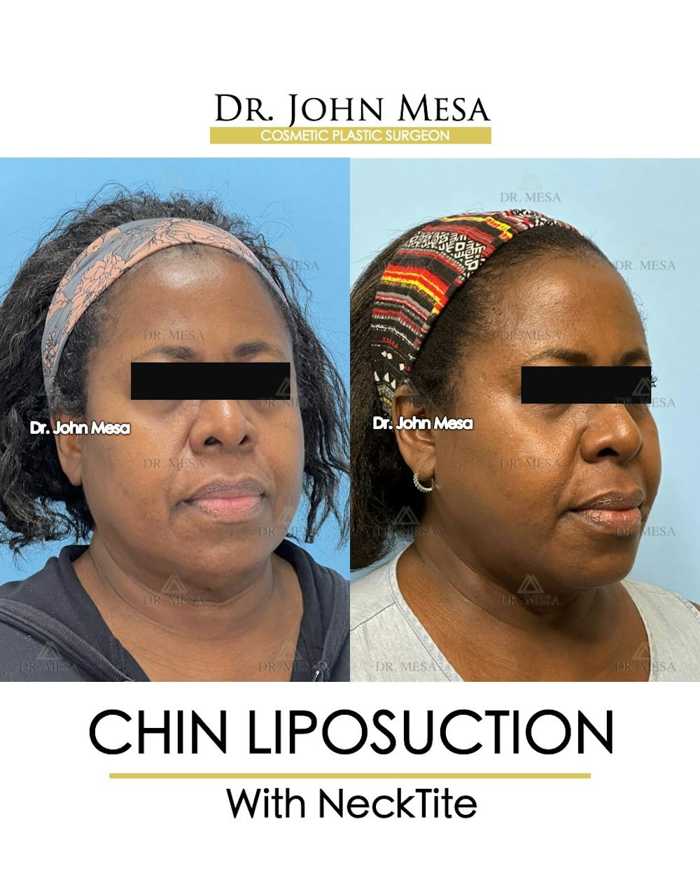 Chin Liposuction Before & After Gallery - Patient 695994 - Image 3