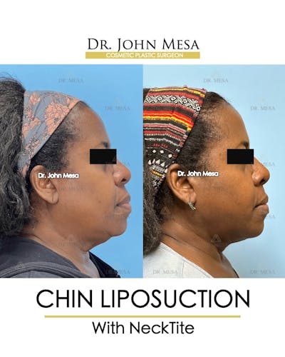 Chin Liposuction Before & After Gallery - Patient 695994 - Image 1