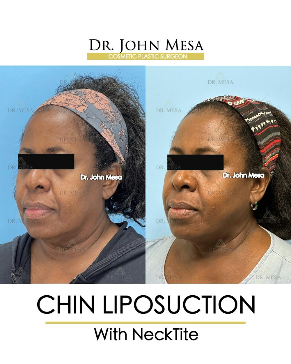 Chin Liposuction Before & After Gallery - Patient 695994 - Image 4