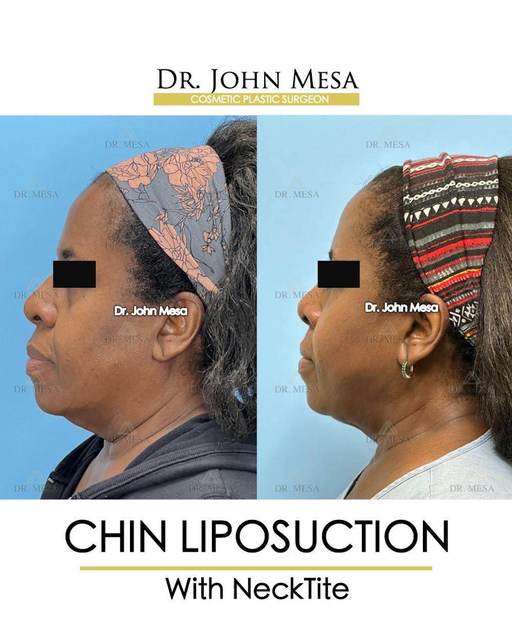 Chin Liposuction Before & After Gallery - Patient 695994 - Image 5