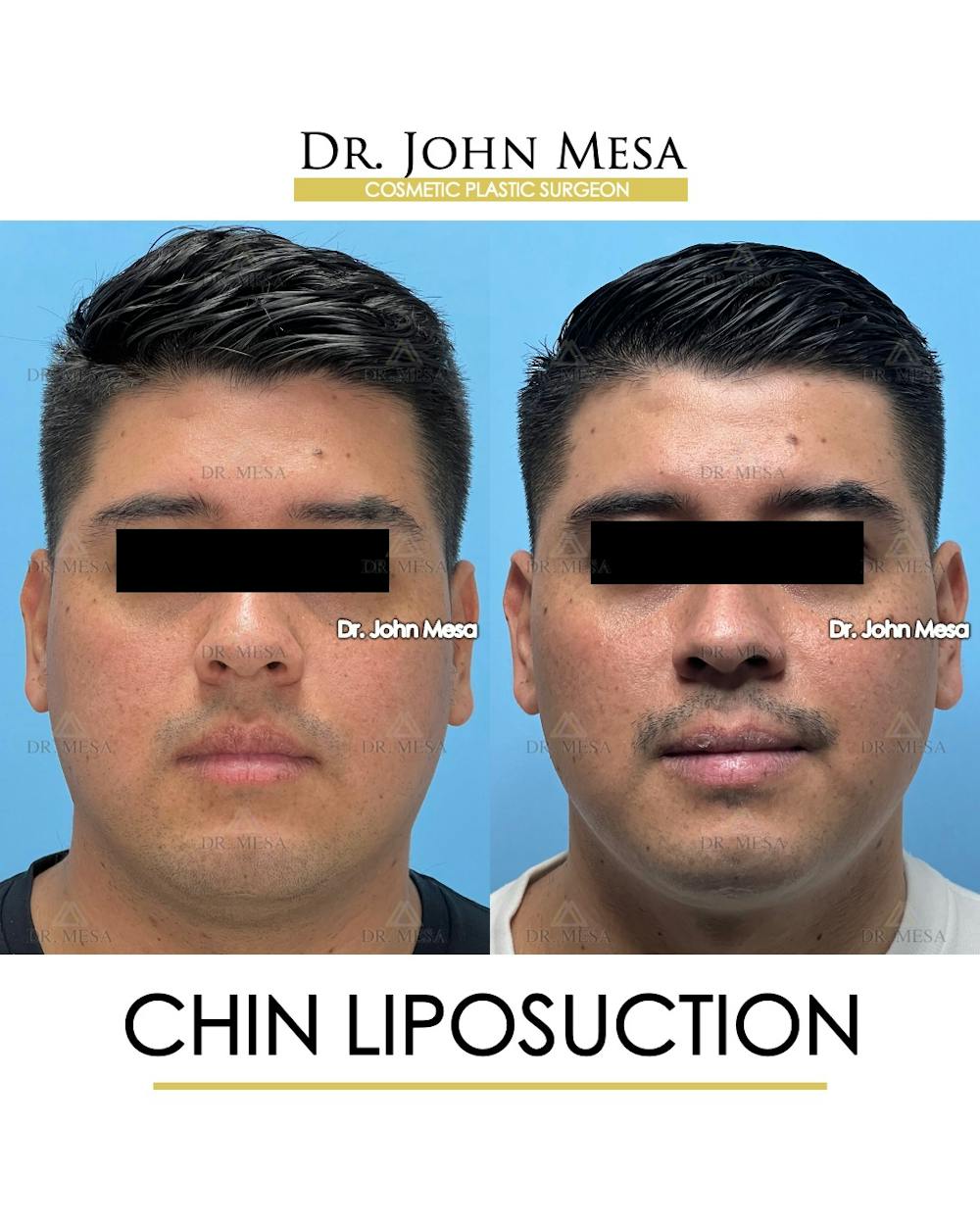 Chin Liposuction Before & After Gallery - Patient 337797 - Image 2