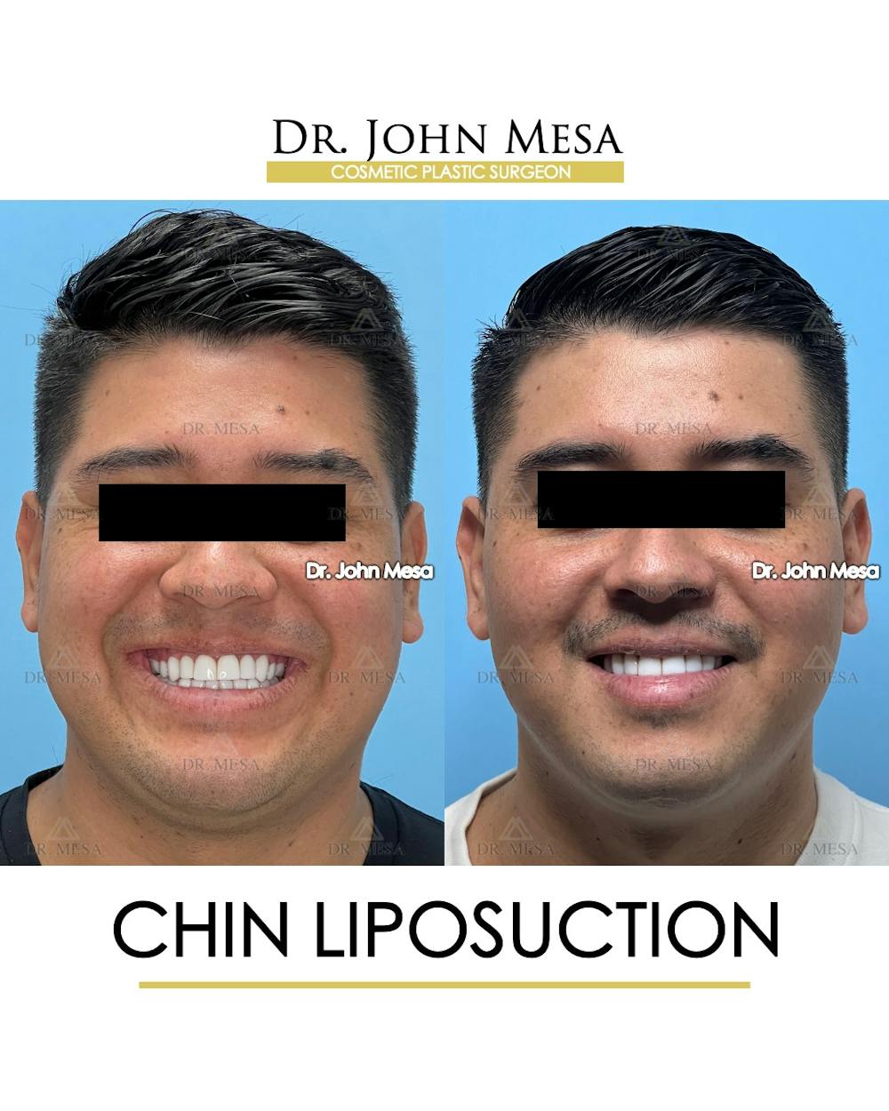 Chin Liposuction Before & After Gallery - Patient 337797 - Image 3