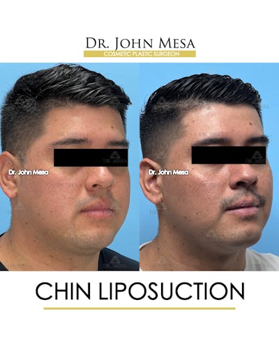 Chin Liposuction Before & After Gallery - Patient 337797 - Image 4
