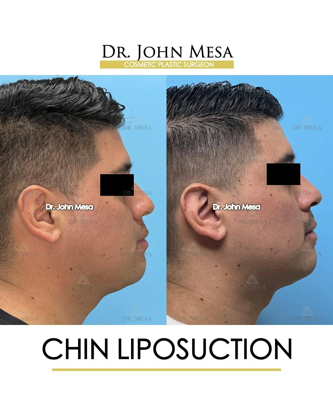 Chin Liposuction Before & After Gallery - Patient 337797 - Image 1