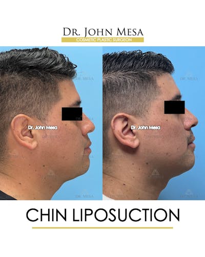 Chin Liposuction Before & After Gallery - Patient 337797 - Image 1