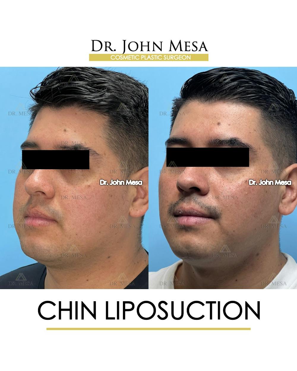 Chin Liposuction Before & After Gallery - Patient 337797 - Image 5