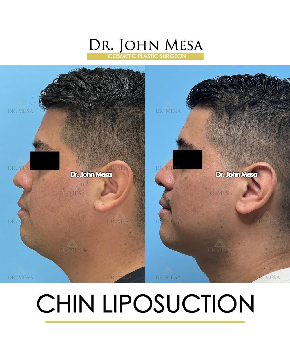 Chin Liposuction Before & After Gallery - Patient 337797 - Image 6