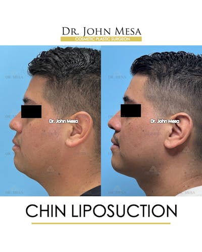 Chin Liposuction Before & After Gallery - Patient 337797 - Image 6