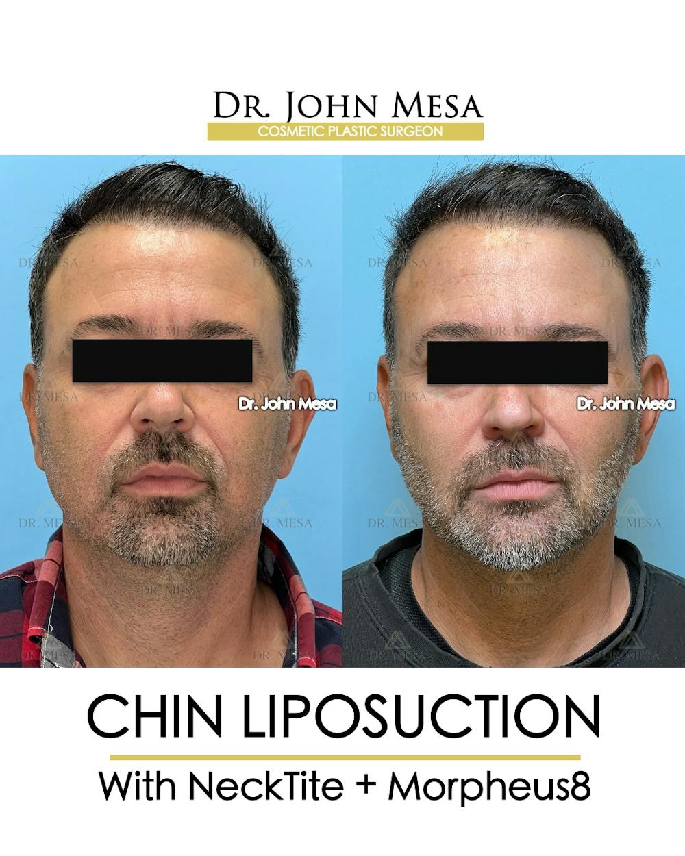 Chin Liposuction Before & After Gallery - Patient 524836 - Image 2