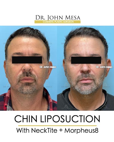 Chin Liposuction Before & After Gallery - Patient 524836 - Image 2