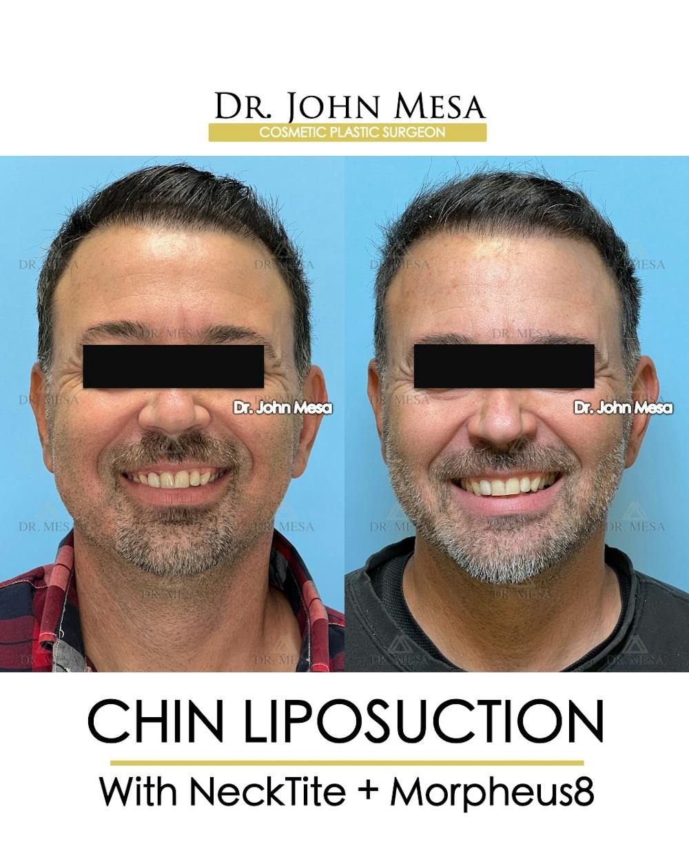 Chin Liposuction Before & After Gallery - Patient 524836 - Image 3