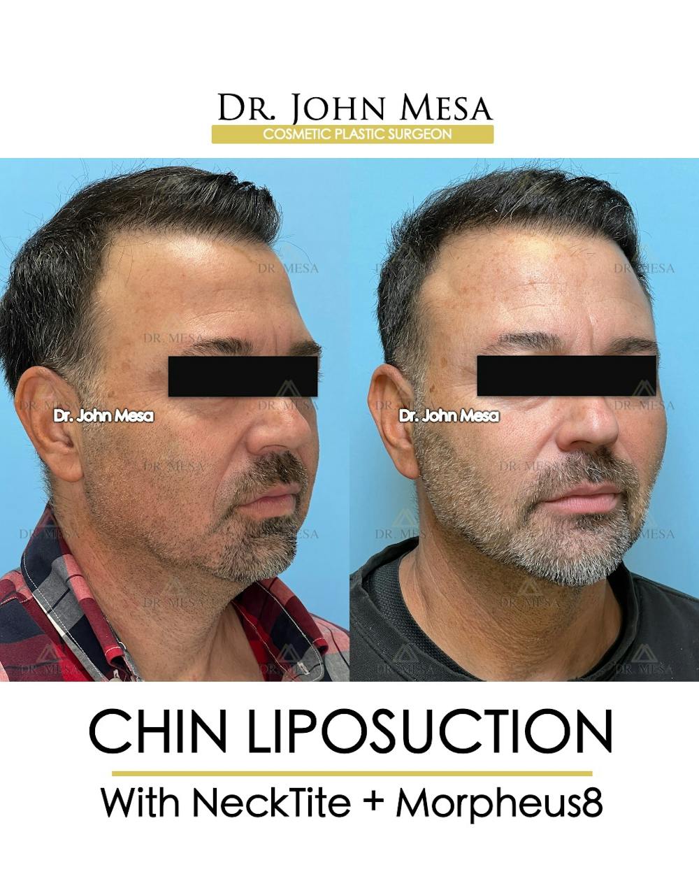 Chin Liposuction Before & After Gallery - Patient 524836 - Image 4