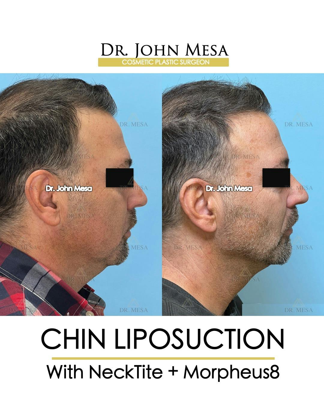 Chin Liposuction Before & After Gallery - Patient 524836 - Image 1