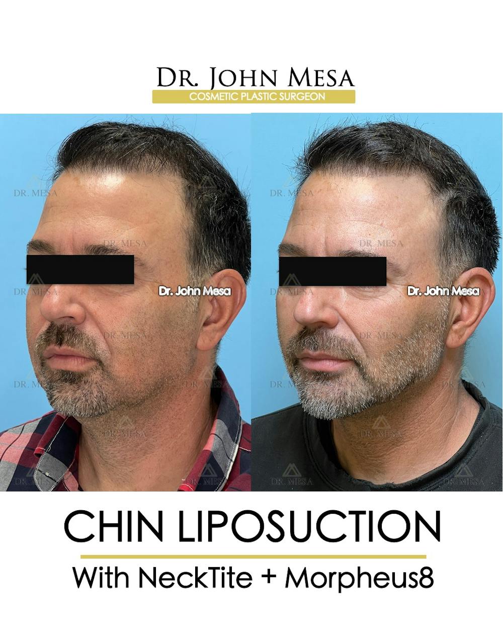 Chin Liposuction Before & After Gallery - Patient 524836 - Image 5