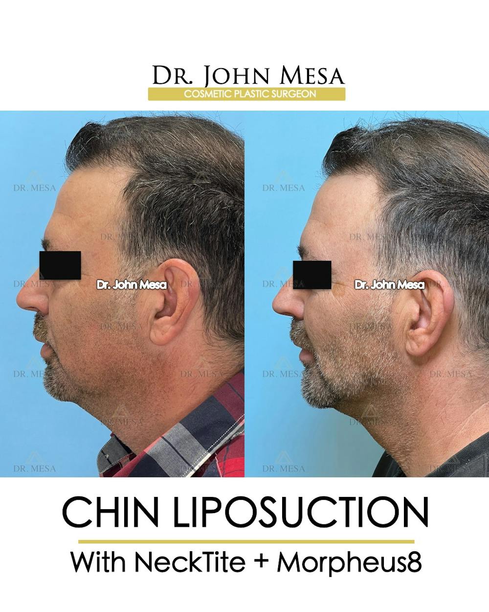Chin Liposuction Before & After Gallery - Patient 524836 - Image 6