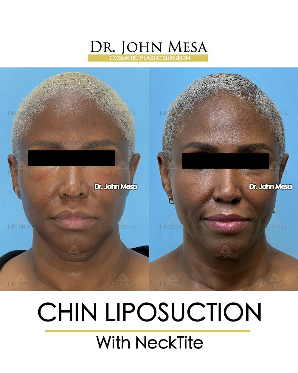 Chin Liposuction Before & After Gallery - Patient 627053 - Image 2