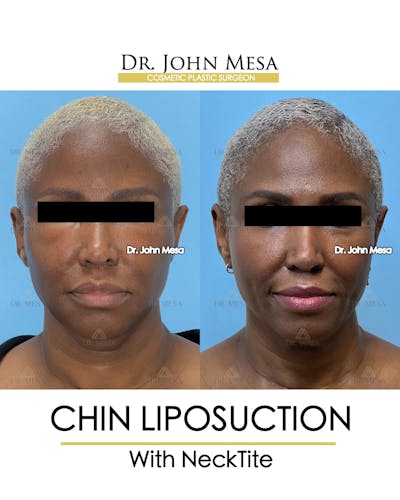 Chin Liposuction Before & After Gallery - Patient 627053 - Image 2