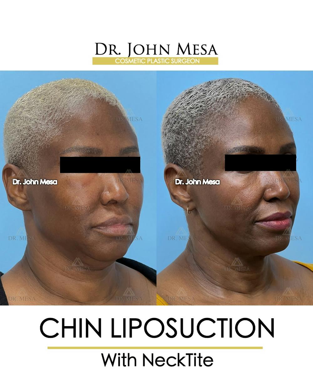 Chin Liposuction Before & After Gallery - Patient 627053 - Image 3