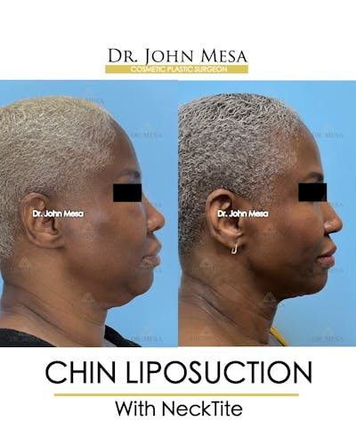 Chin Liposuction Before & After Gallery - Patient 627053 - Image 1
