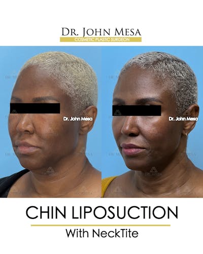 Chin Liposuction Before & After Gallery - Patient 627053 - Image 4