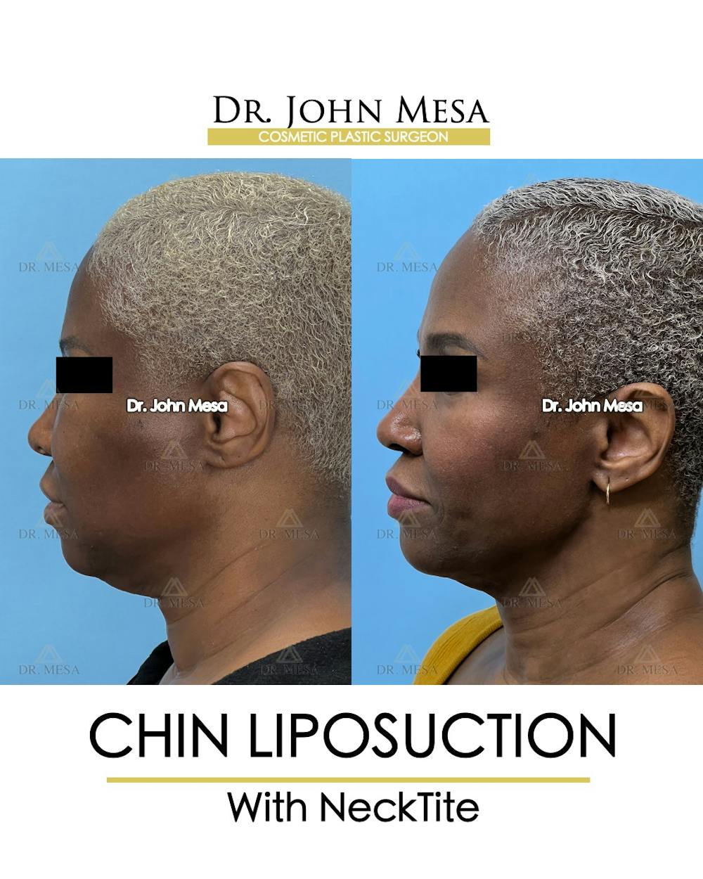 Chin Liposuction Before & After Gallery - Patient 627053 - Image 5