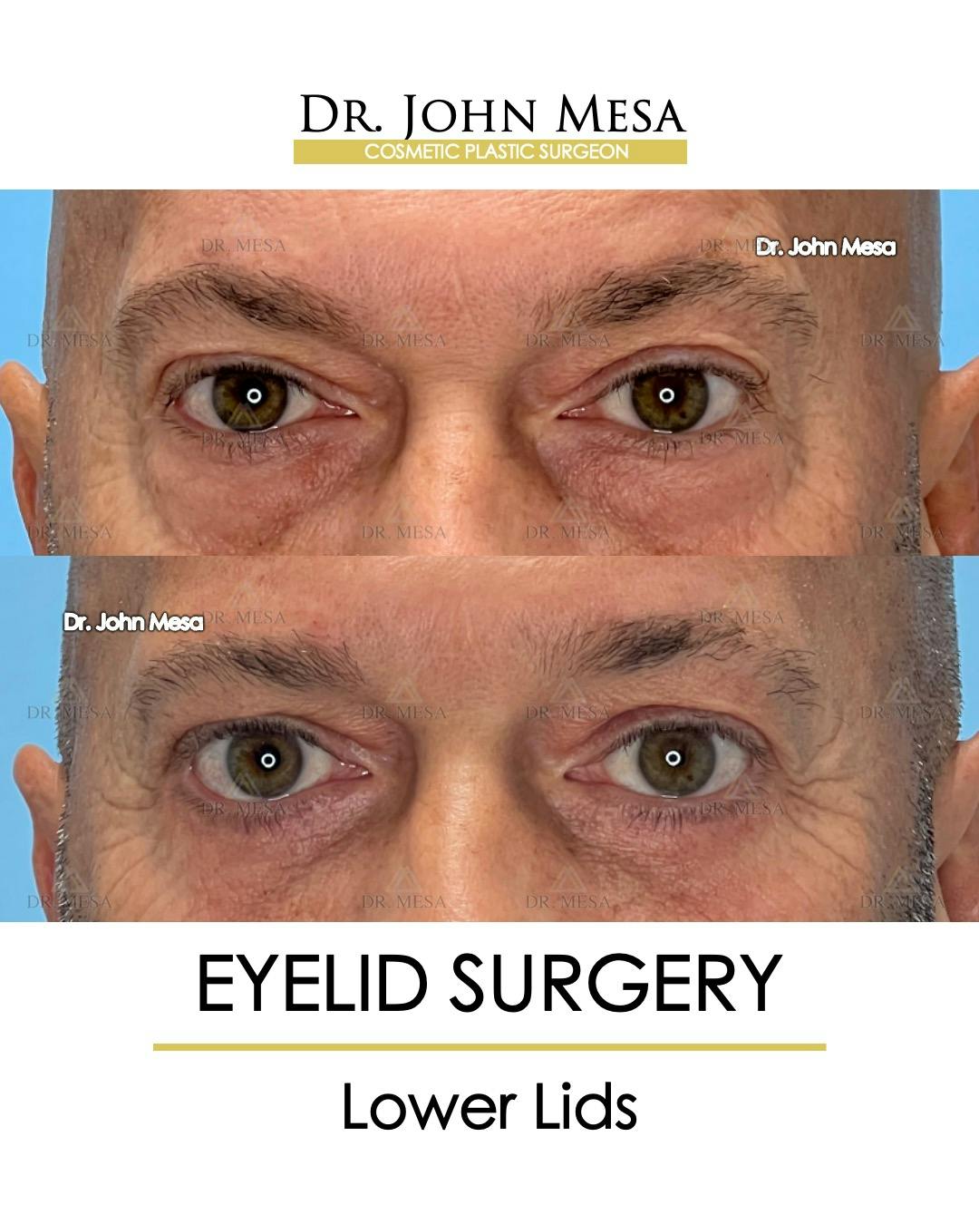 Eyelid Surgery Before & After Gallery - Patient 213326 - Image 1