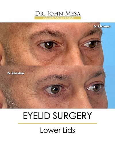 Eyelid Surgery Before & After Gallery - Patient 213326 - Image 2