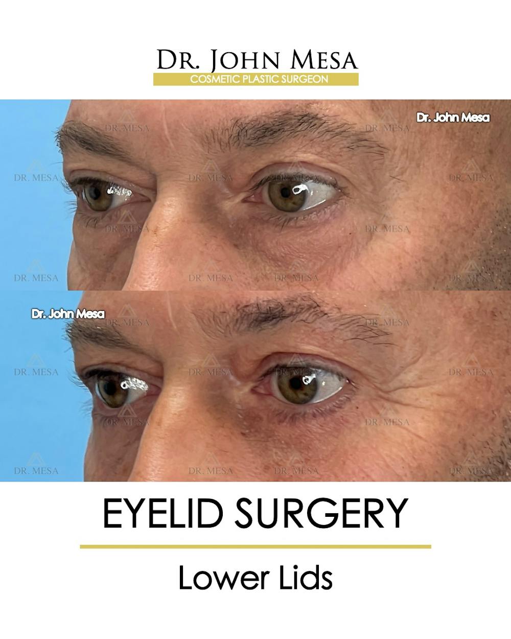 Eyelid Surgery Before & After Gallery - Patient 213326 - Image 3
