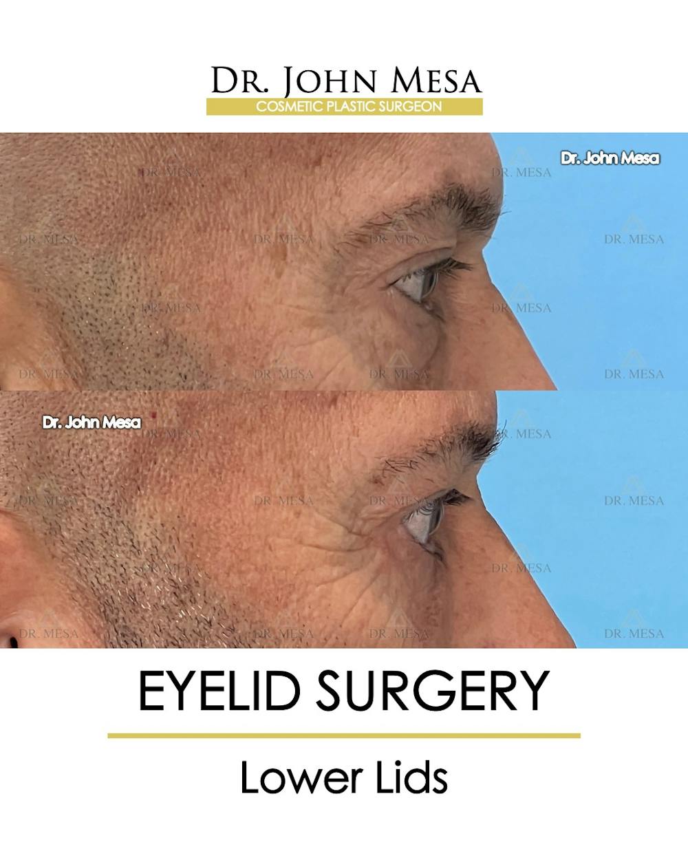 Eyelid Surgery Before & After Gallery - Patient 213326 - Image 4