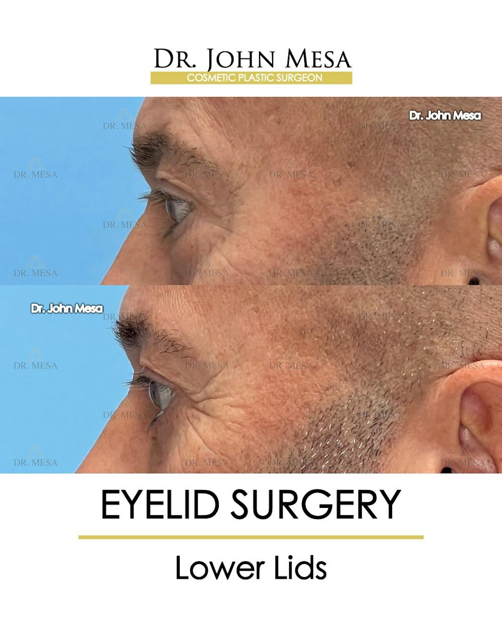 Eyelid Surgery Before & After Gallery - Patient 213326 - Image 5