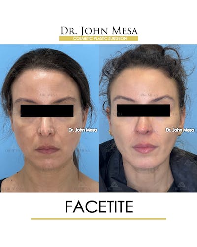 FaceTite Before & After Gallery - Patient 246520 - Image 1