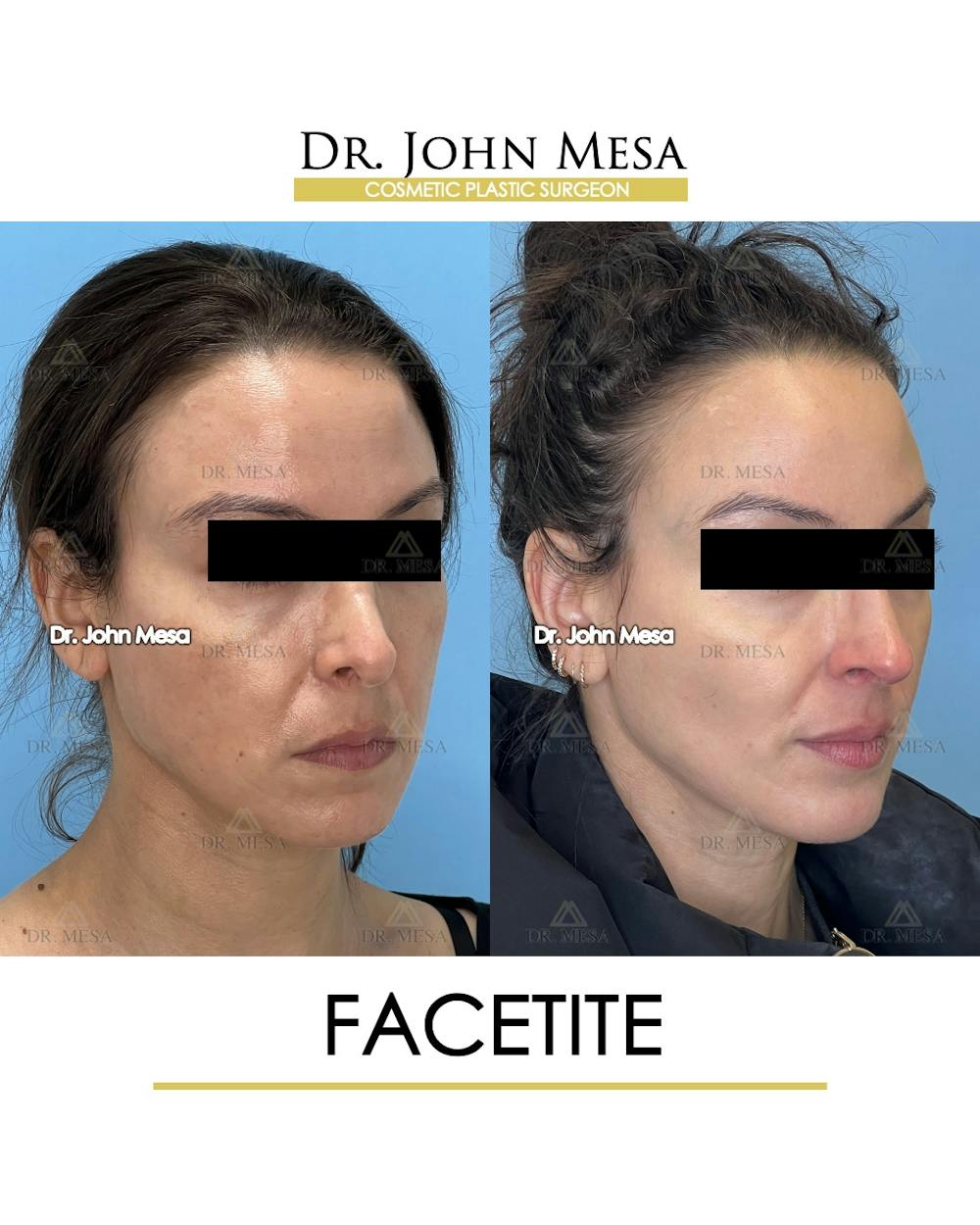 FaceTite Before & After Gallery - Patient 246520 - Image 2